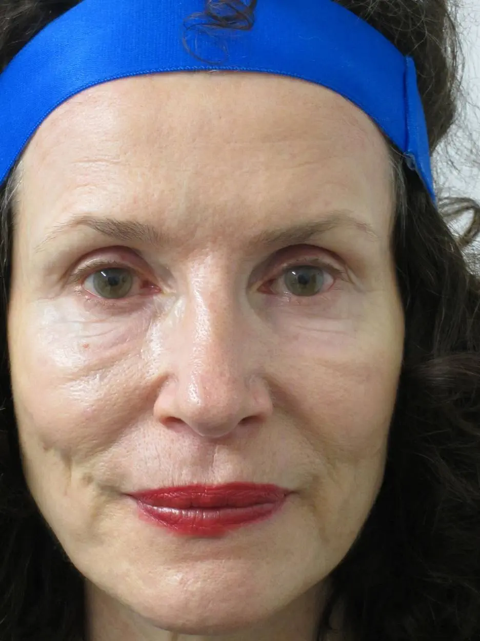 anti wrinkle gallery 01 after