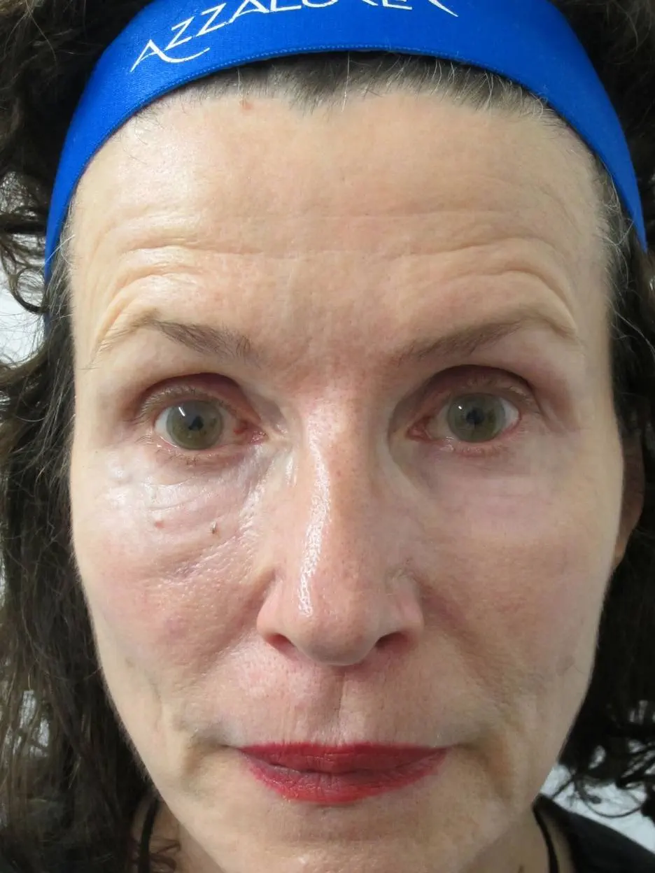 anti wrinkle gallery 01 before