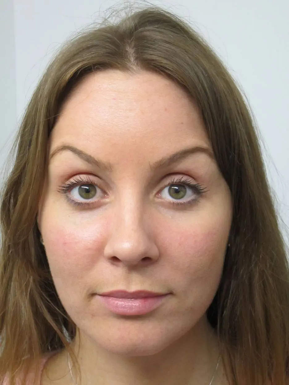 anti wrinkle gallery 01 after