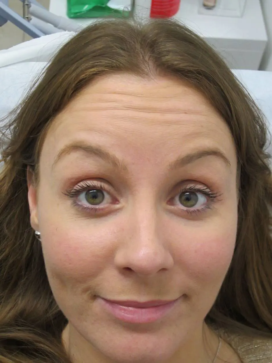 anti wrinkle gallery 01 before