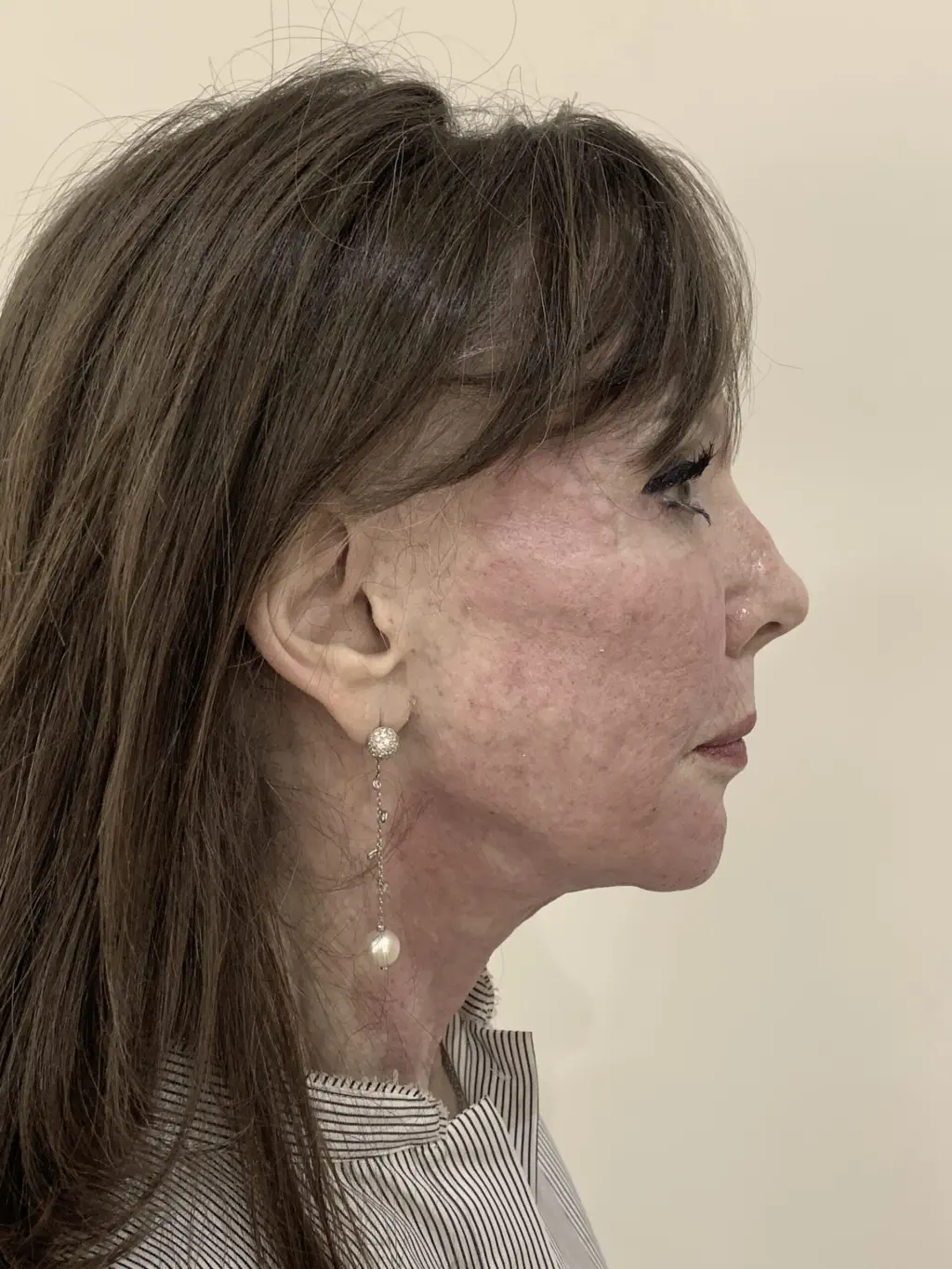 anti wrinkle gallery 01 before