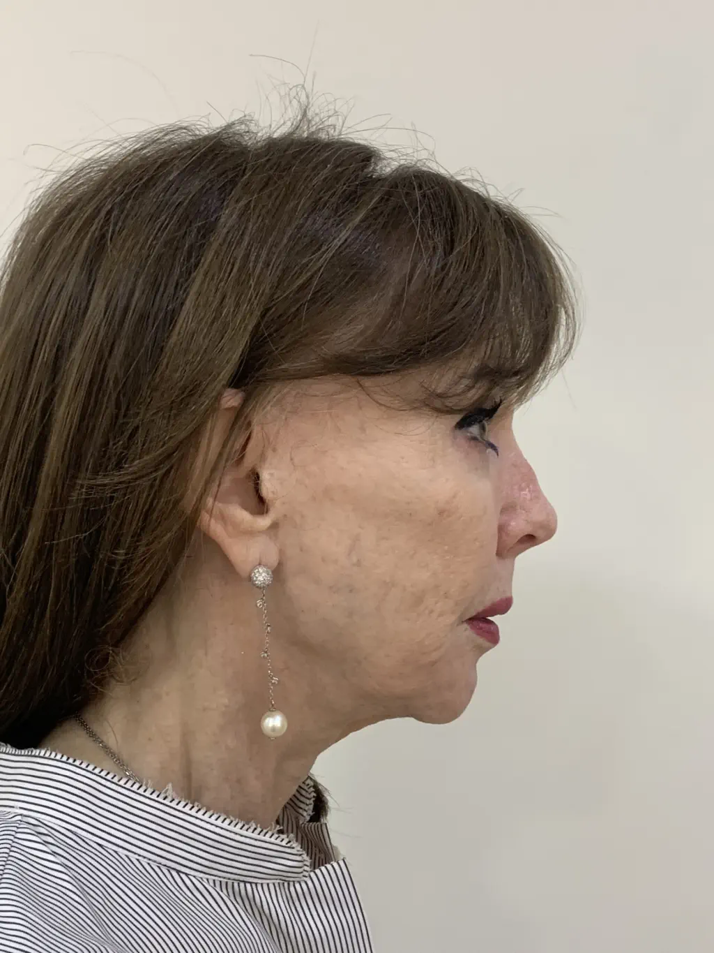 anti wrinkle gallery 01 before