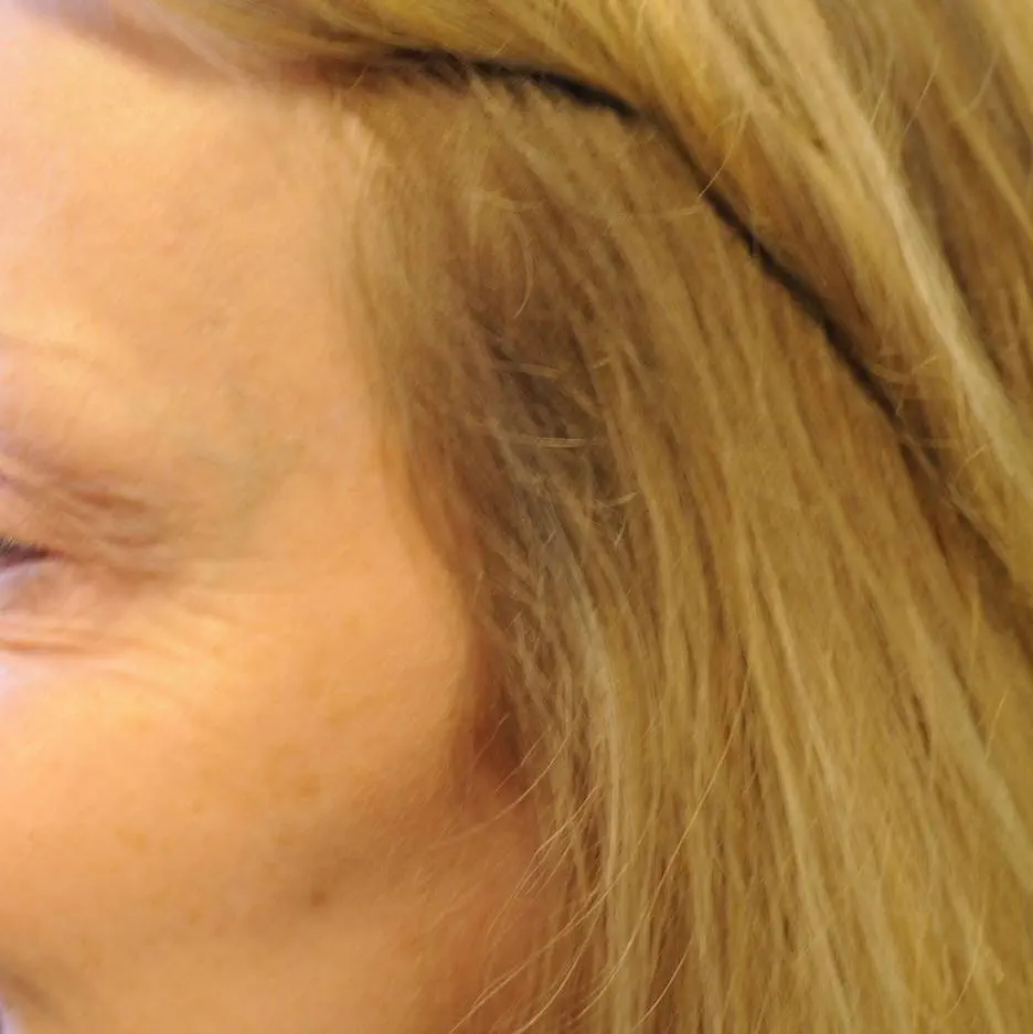 anti wrinkle gallery 01 before