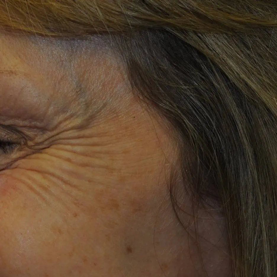 anti wrinkle gallery 01 before