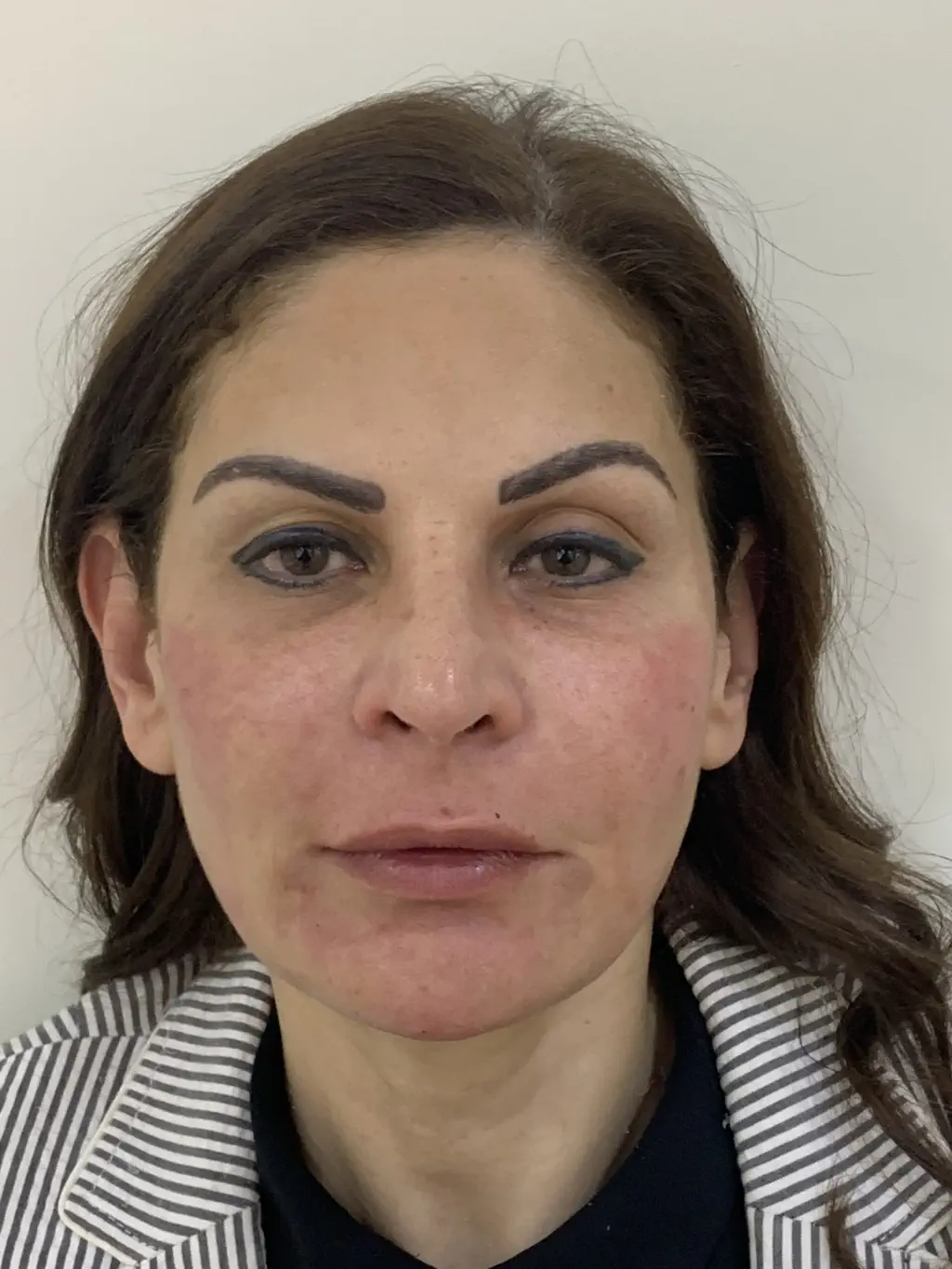 anti wrinkle gallery 01 after