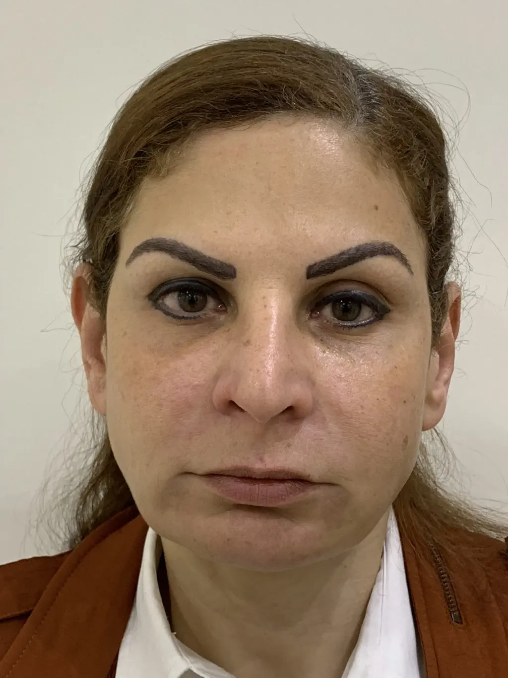 anti wrinkle gallery 01 before