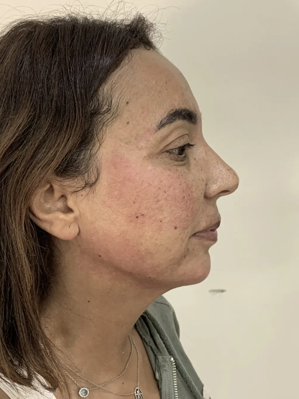 anti wrinkle gallery 01 after