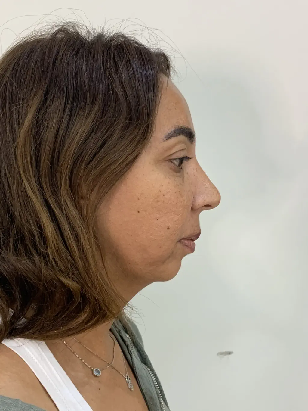 anti wrinkle gallery 01 before