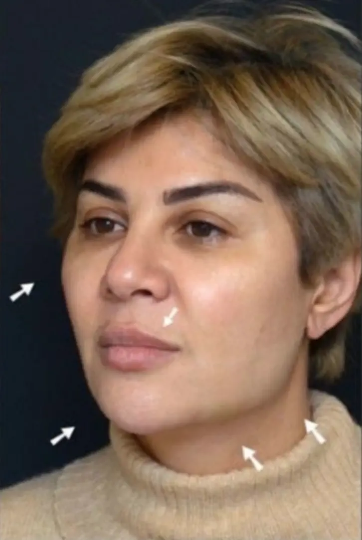 anti wrinkle gallery 01 before