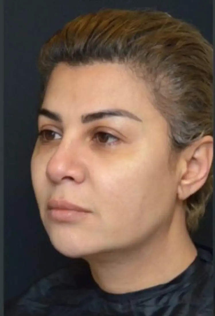 anti wrinkle gallery 01 before