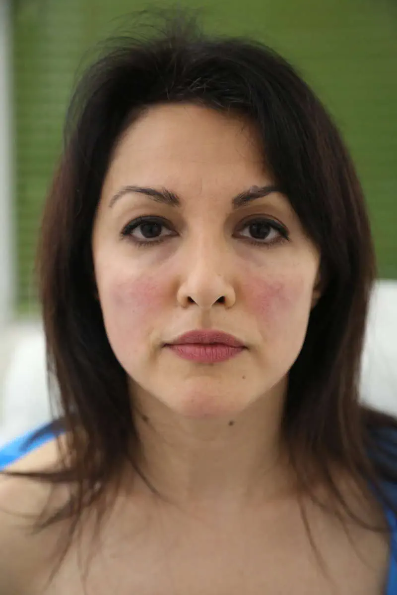 anti wrinkle gallery 01 before