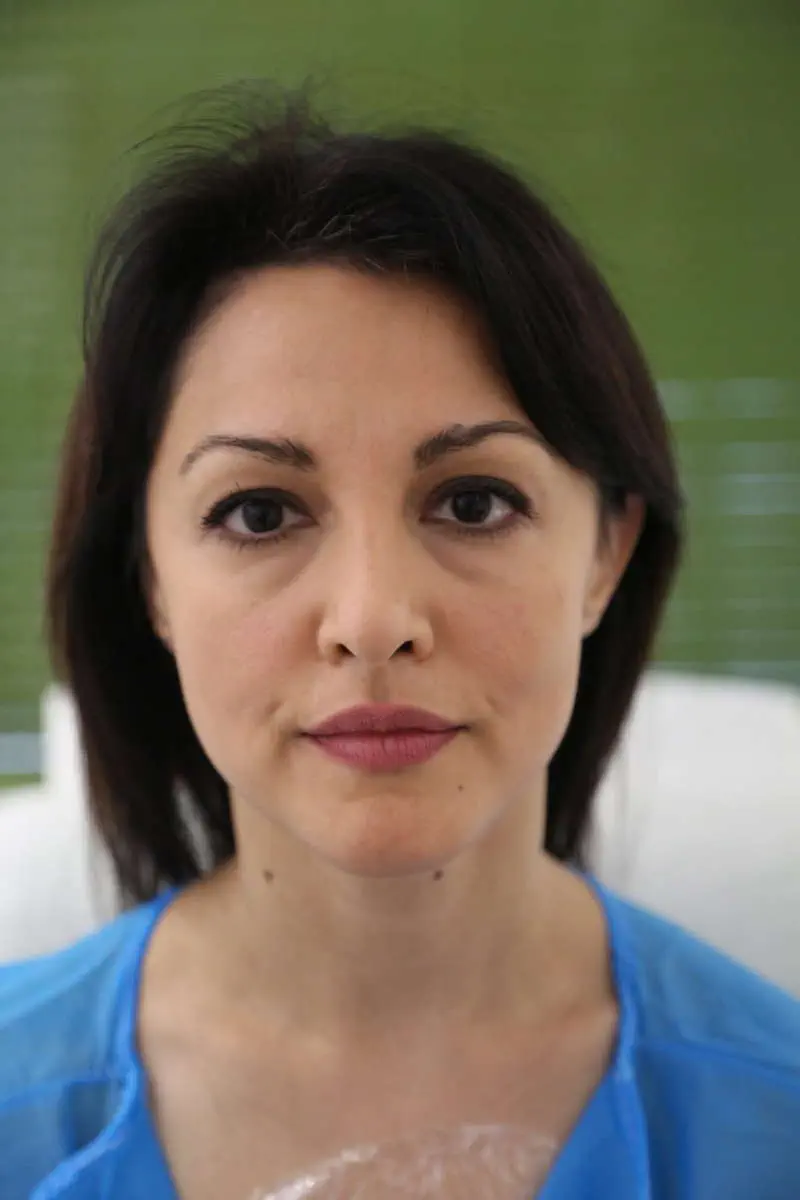 anti wrinkle gallery 01 before