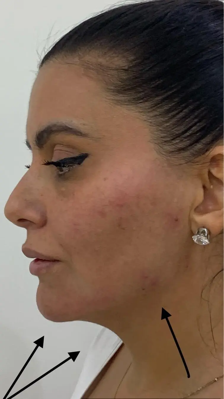 anti wrinkle gallery 01 before