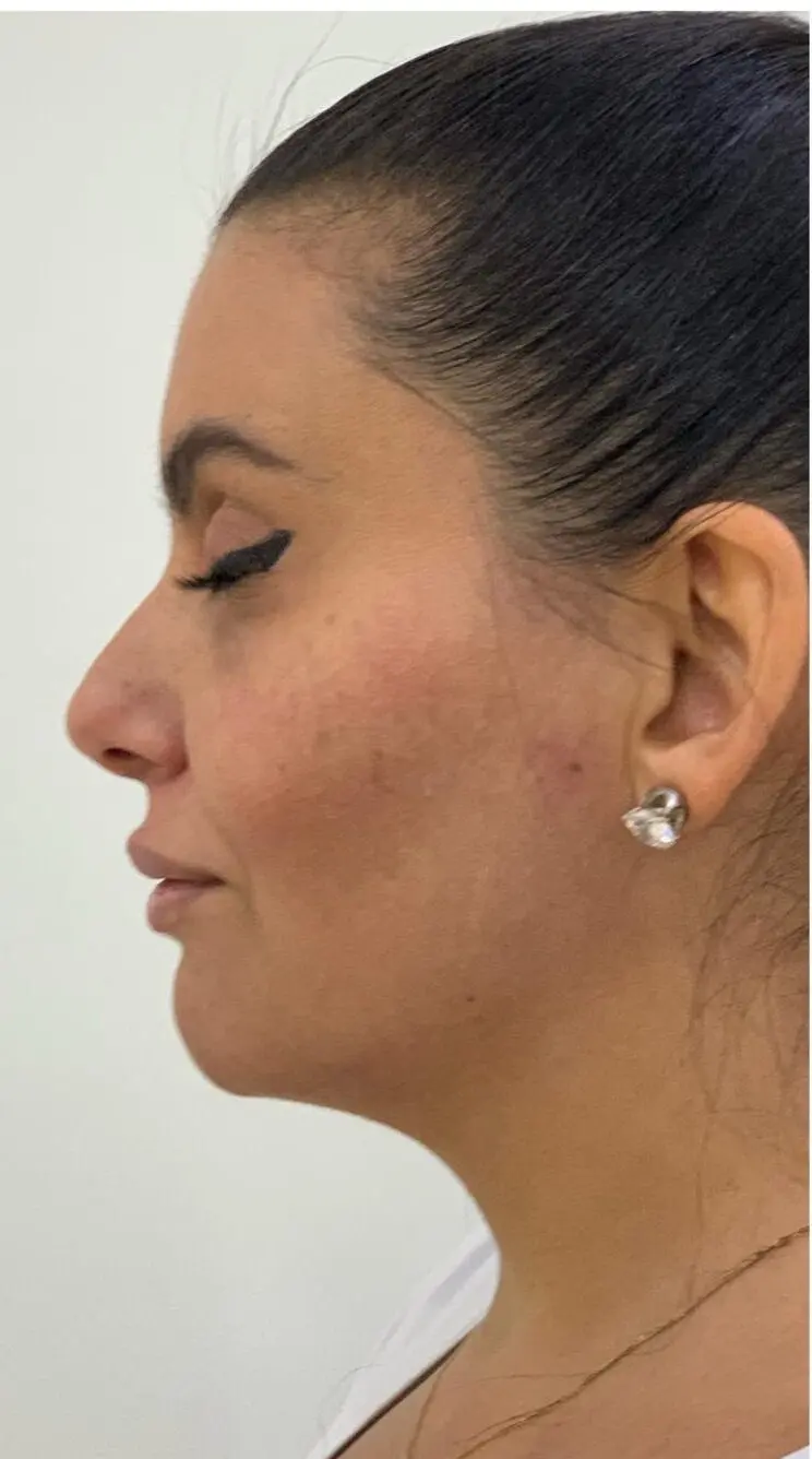 anti wrinkle gallery 01 before