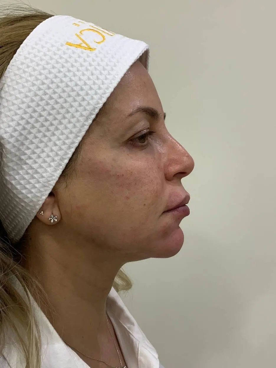 anti wrinkle gallery 01 before