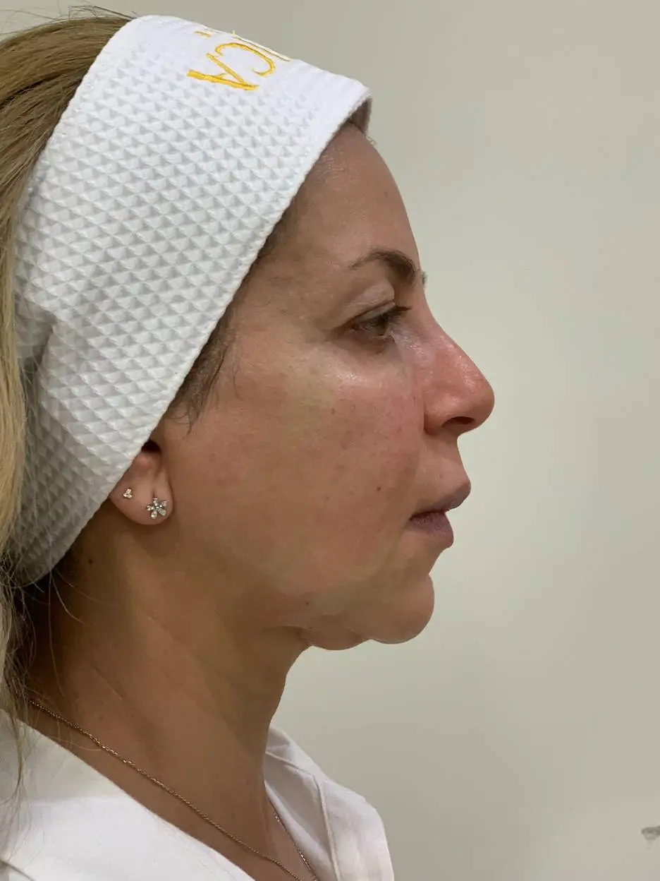 anti wrinkle gallery 01 before