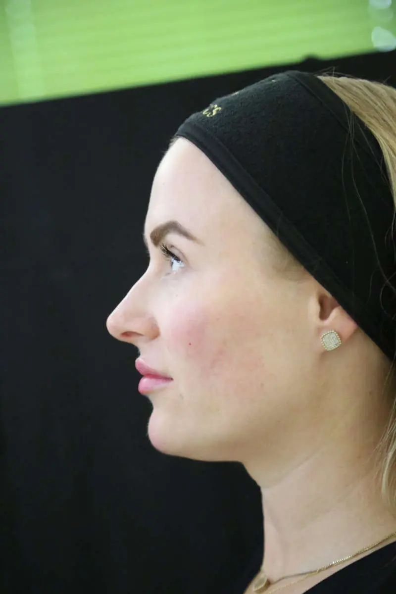 anti wrinkle gallery 01 before