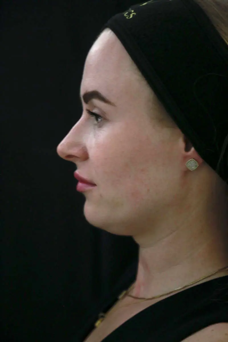 anti wrinkle gallery 01 before