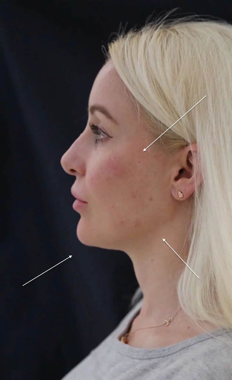 anti wrinkle gallery 01 before