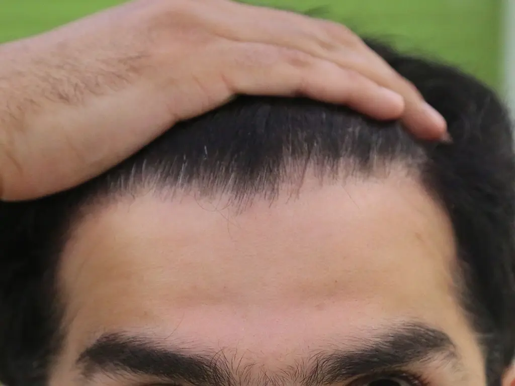 anti wrinkle gallery 01 before