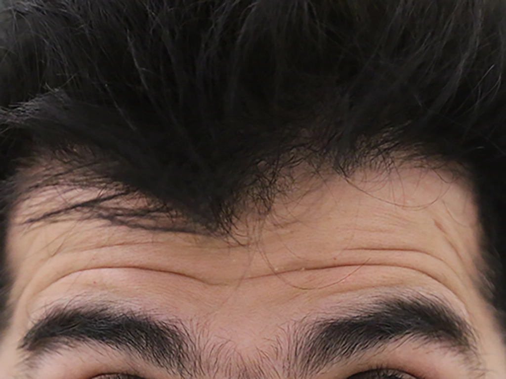 anti wrinkle gallery 01 before