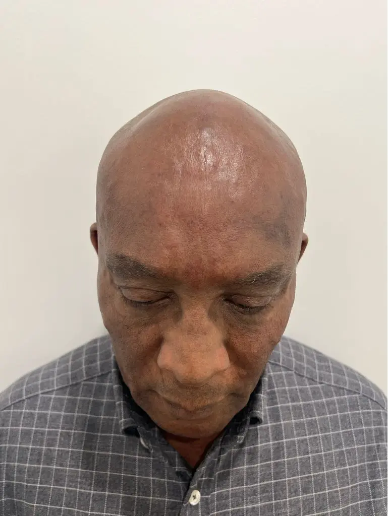 anti wrinkle gallery 01 before