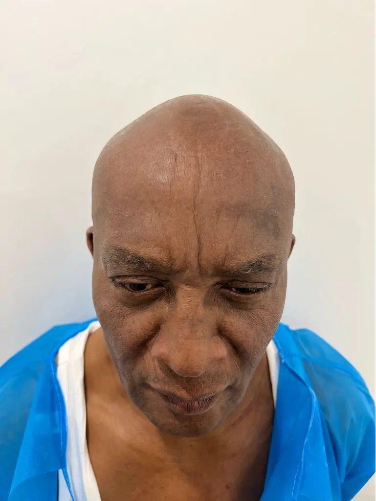 anti wrinkle gallery 01 before