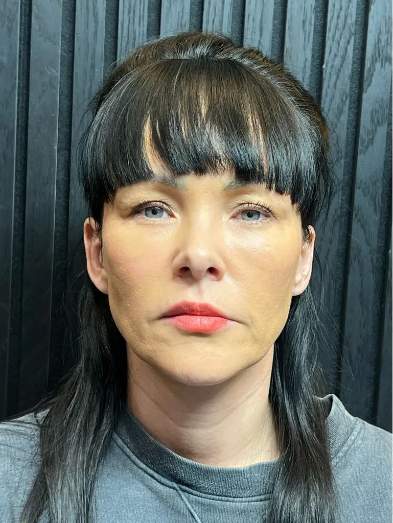 anti wrinkle gallery 01 before