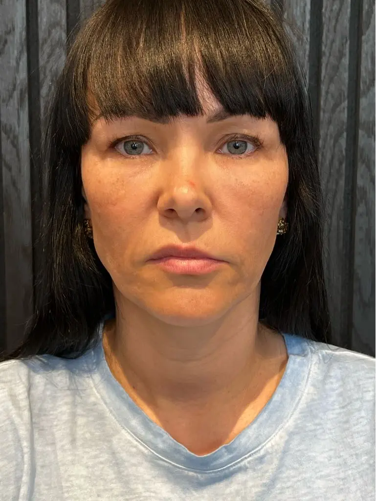 anti wrinkle gallery 01 before