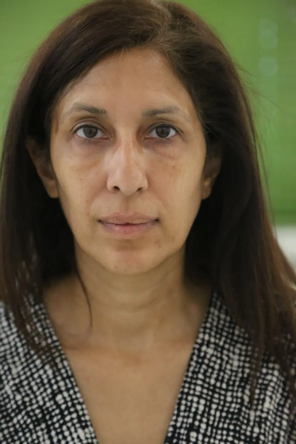 anti wrinkle gallery 01 before