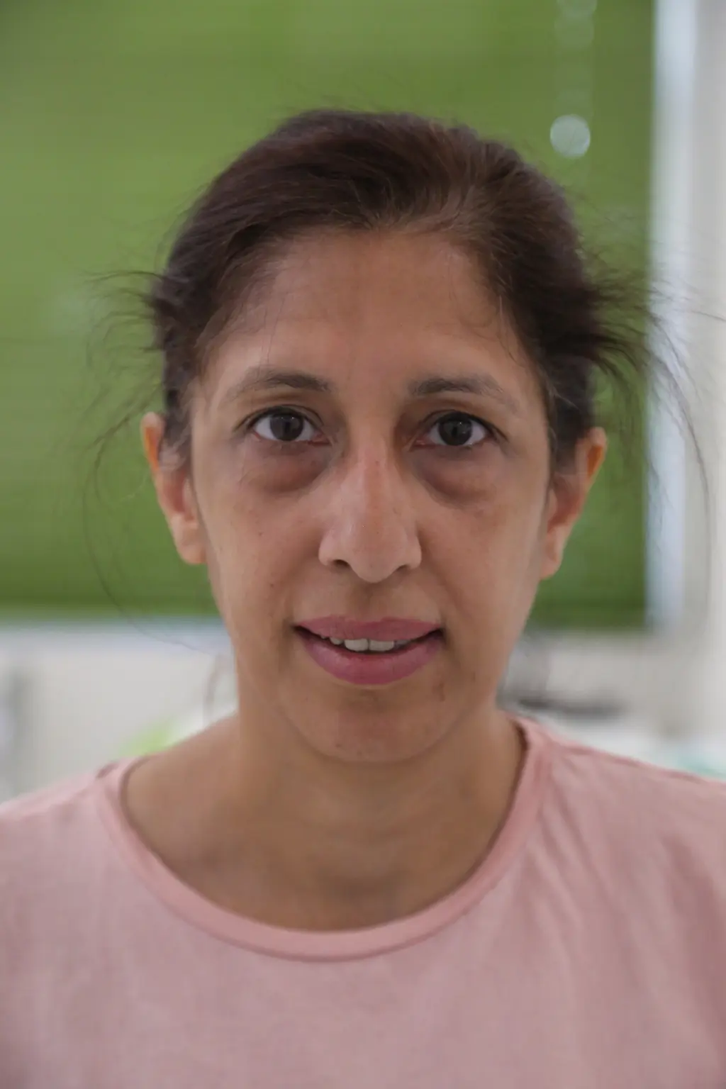 anti wrinkle gallery 01 before