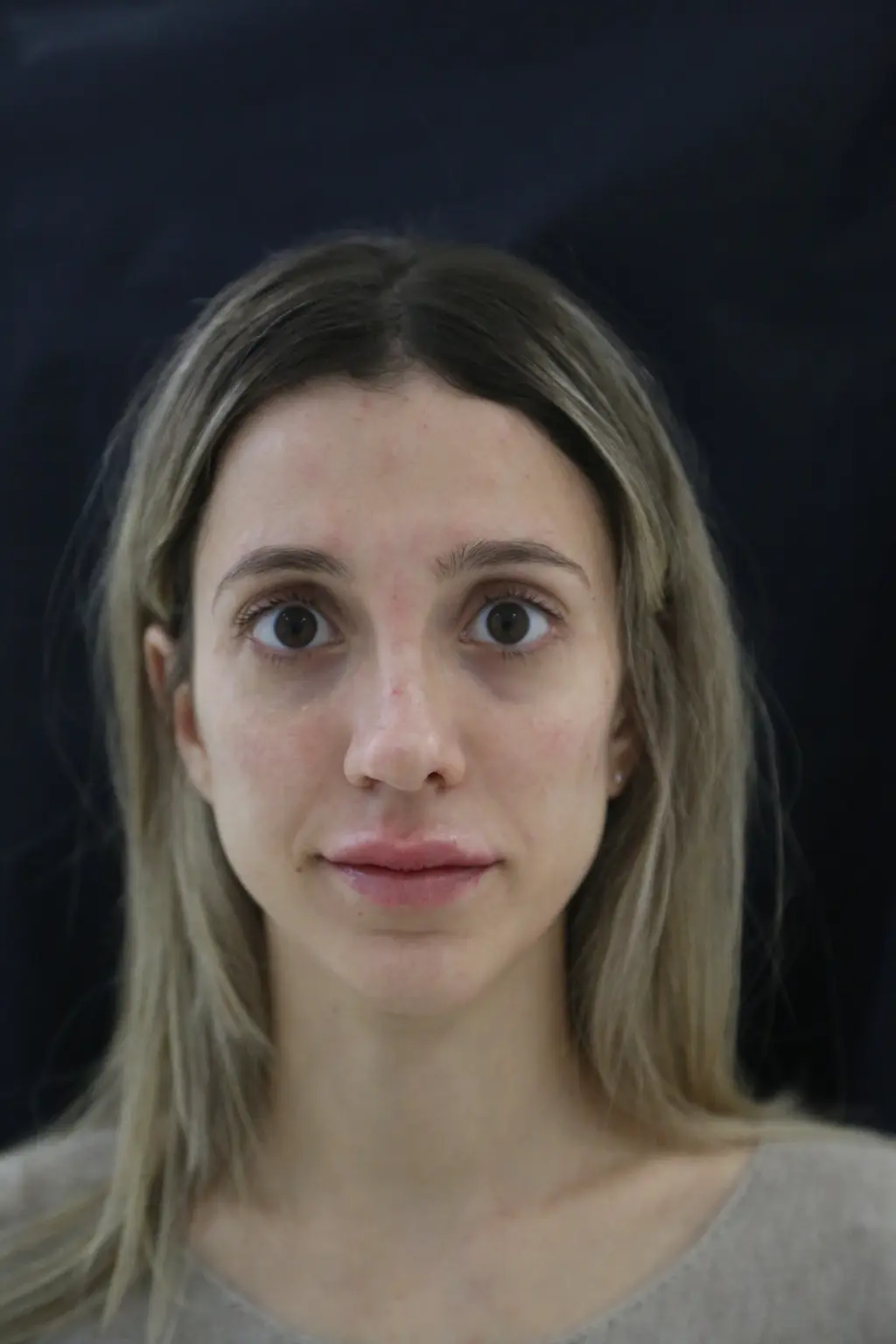 anti wrinkle gallery 01 before