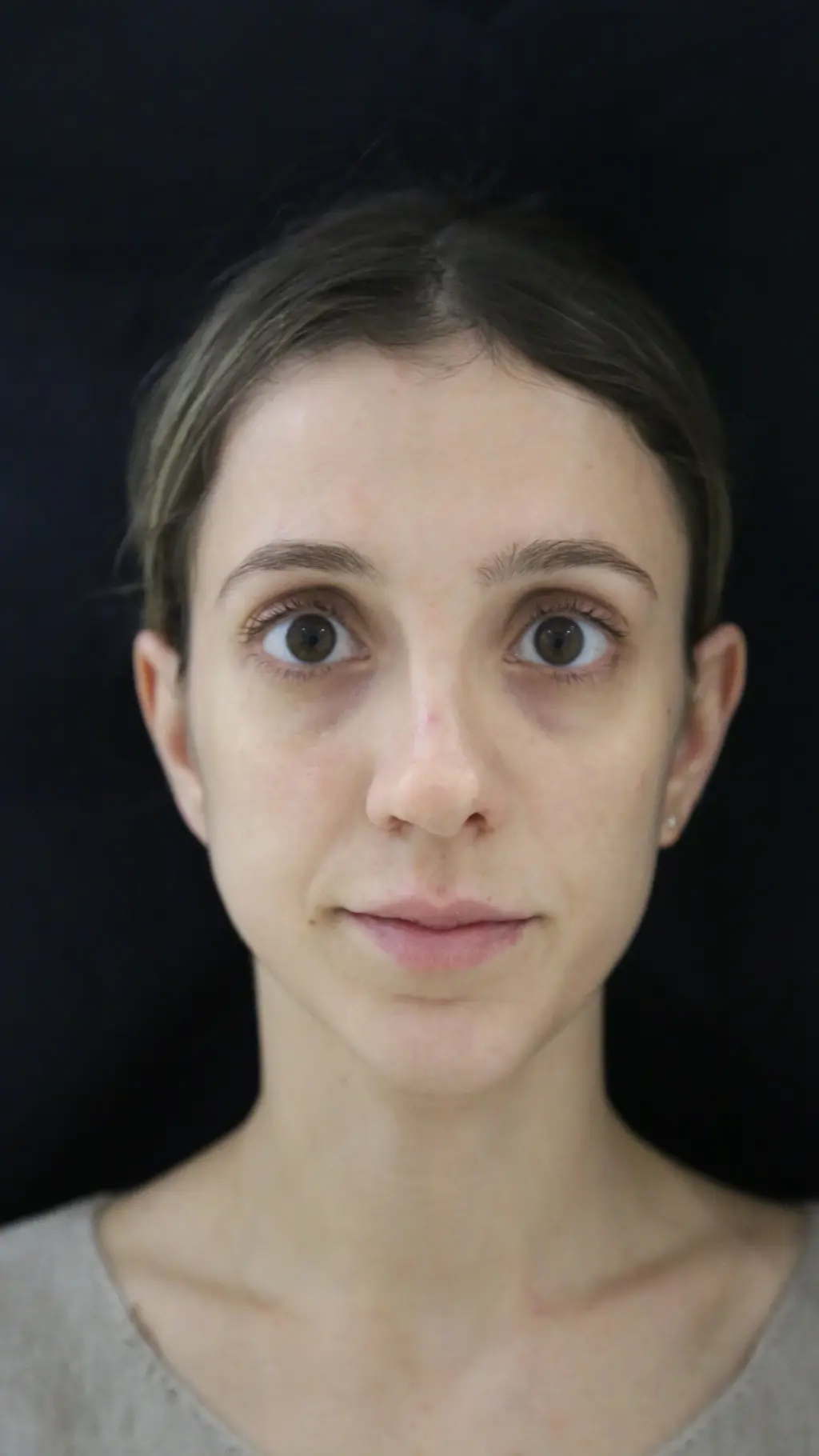 anti wrinkle gallery 01 before